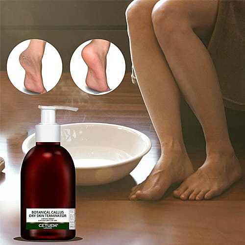 Cetuem: Botanical Callus Dry Skin Terminator - 150ml (Free Hydrating Foot Cream - 100ml)
