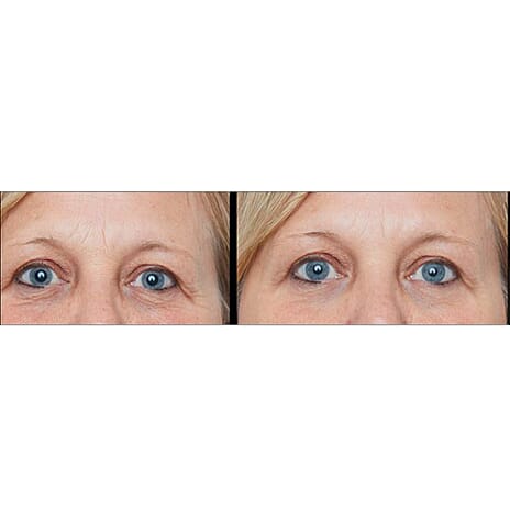 Lab Life Beauty Photon - White - Exclusive Lifetime Warranty