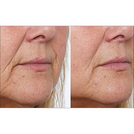 Lab Life Beauty Photon - White - Exclusive Lifetime Warranty