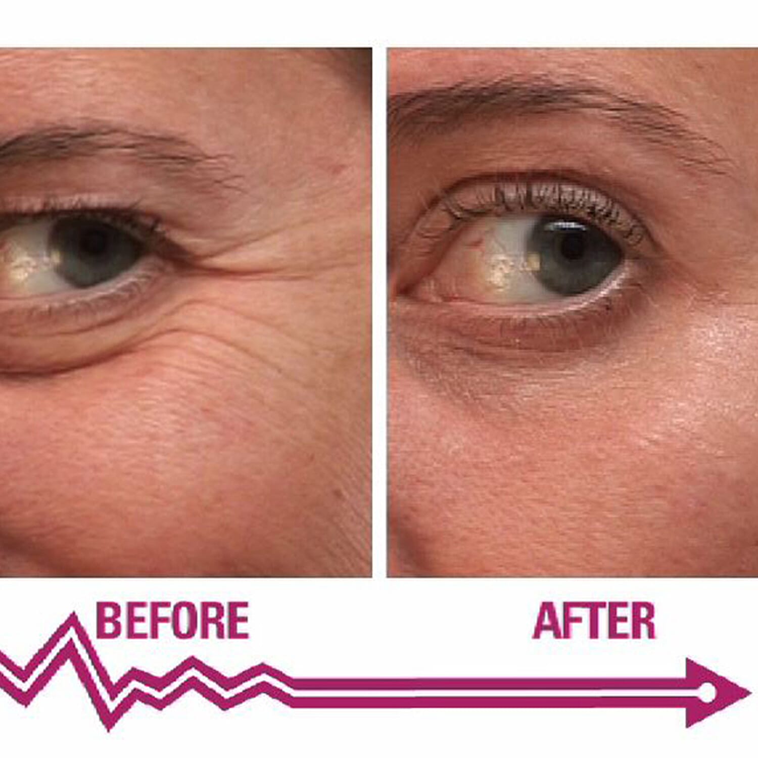 SKINEANCE Wrinkle Filler - Fills and Smoothes Fine Lines & Wrinkles Immediately - 15ml