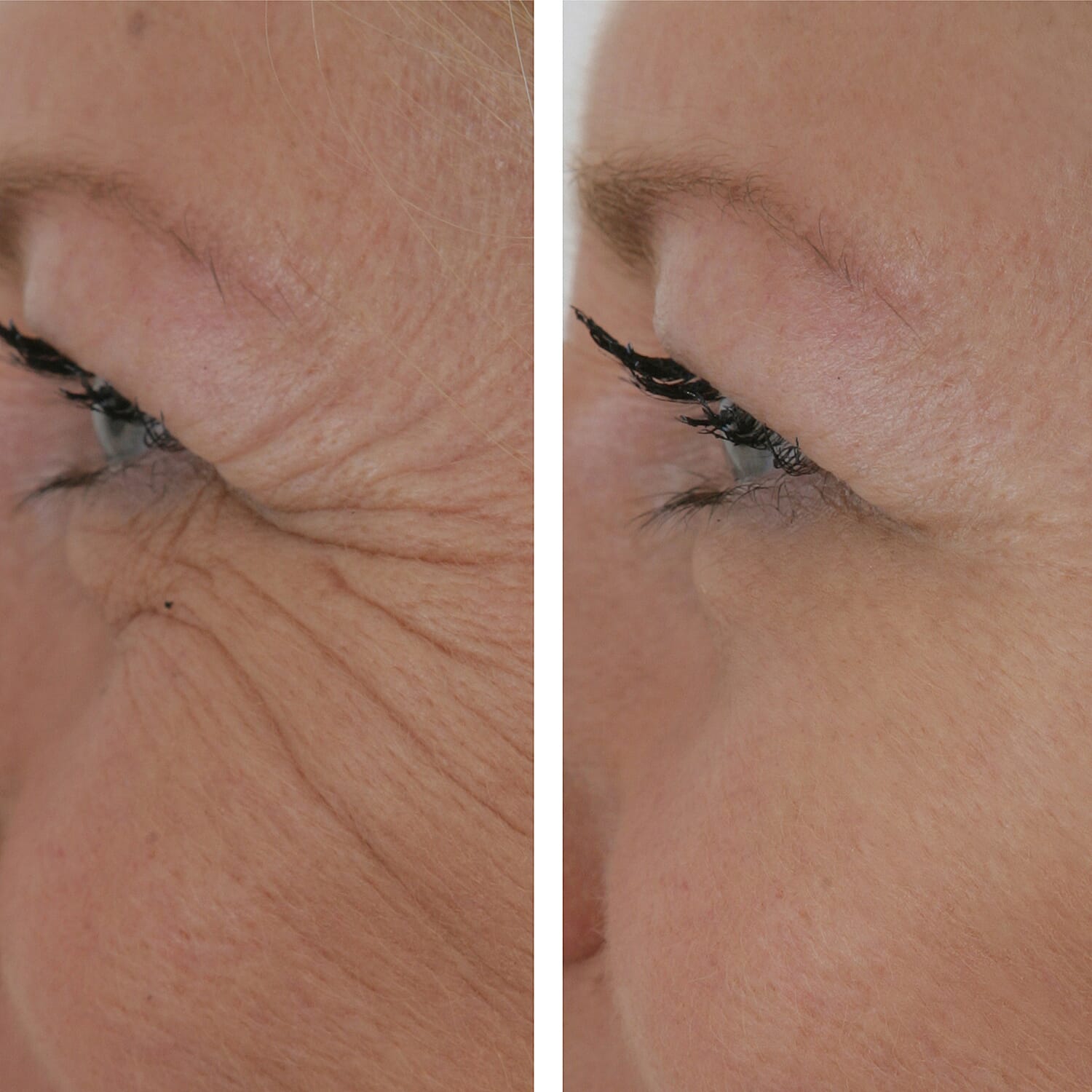 SKINEANCE Wrinkle Filler - Fills and Smoothes Fine Lines & Wrinkles Immediately - 15ml