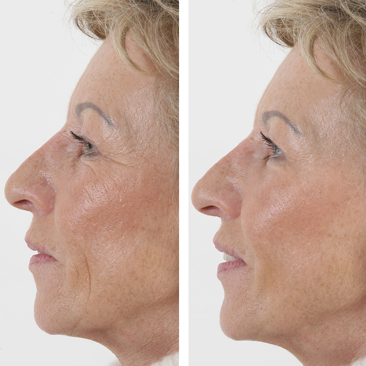 SKINEANCE Wrinkle Filler - Fills and Smoothes Fine Lines & Wrinkles Immediately - 15ml