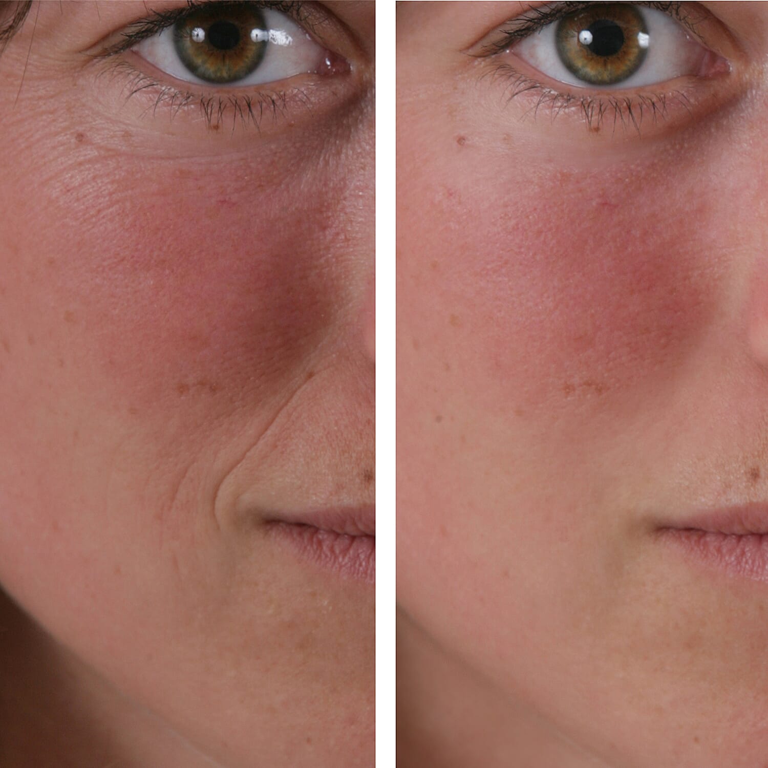 SKINEANCE Wrinkle Filler - Fills and Smoothes Fine Lines & Wrinkles Immediately - 15ml