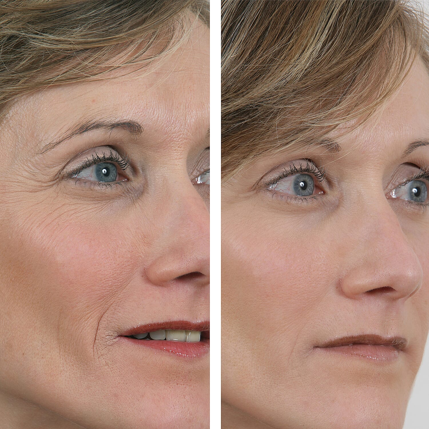 SKINEANCE Wrinkle Filler - Fills and Smoothes Fine Lines & Wrinkles Immediately - 15ml