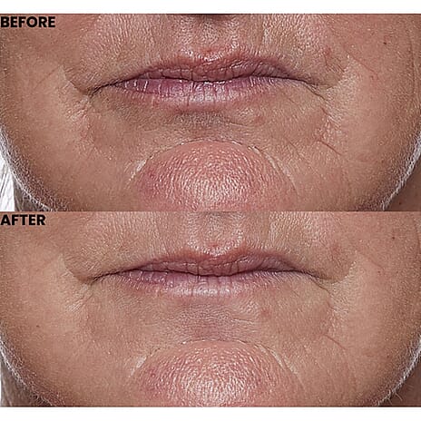 Lab Life Deciem - RF, LIF, MFIP and VR Technology (Lifetime Warranty)