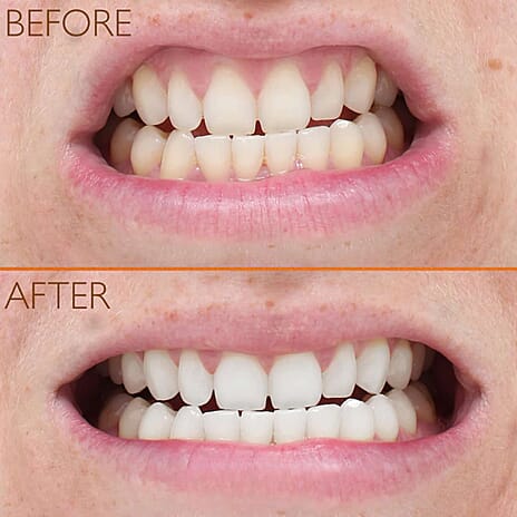 LAST CHANCE STOCK - Lab Life Eclipse Whitening System (Incl. Eclipse, UV Charger, Whitening Serum - Enamel Serum)